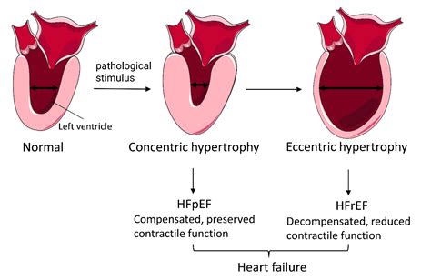 concentric lv hypertrophy|left ventricular hypertrophy risk factors.